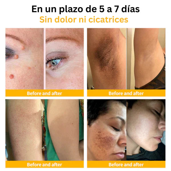 Tag Recede Eliminador de verrugas