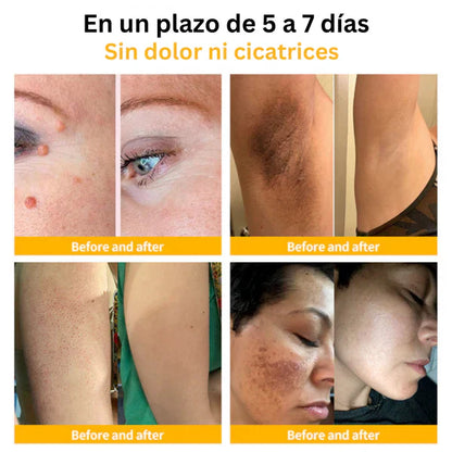Tag Recede Eliminador de verrugas